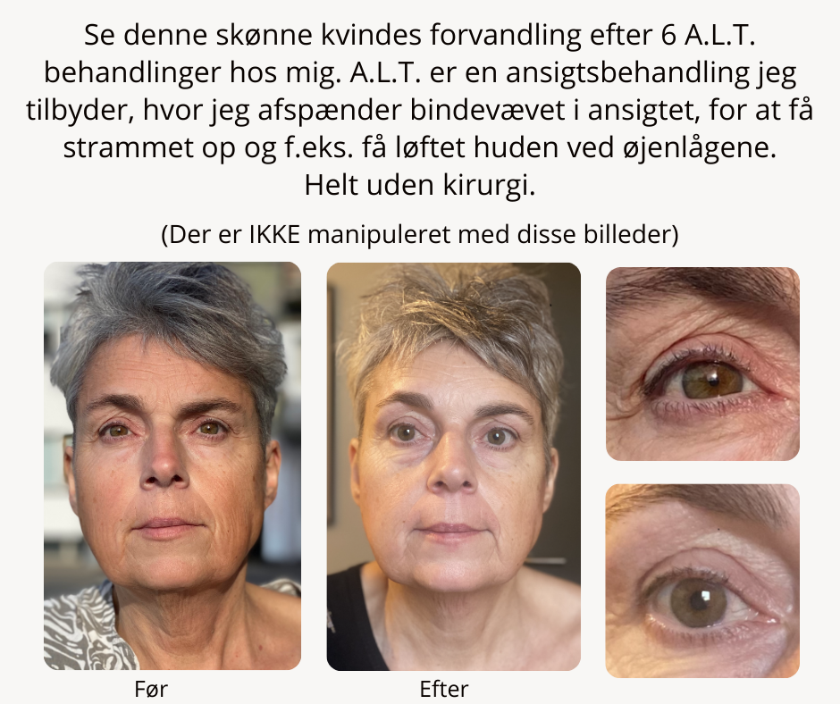 A.L.T. (AnsigtsLøftningsTeknik) Før A.L.T. (AnsigtsLøftningsTeknik) Før