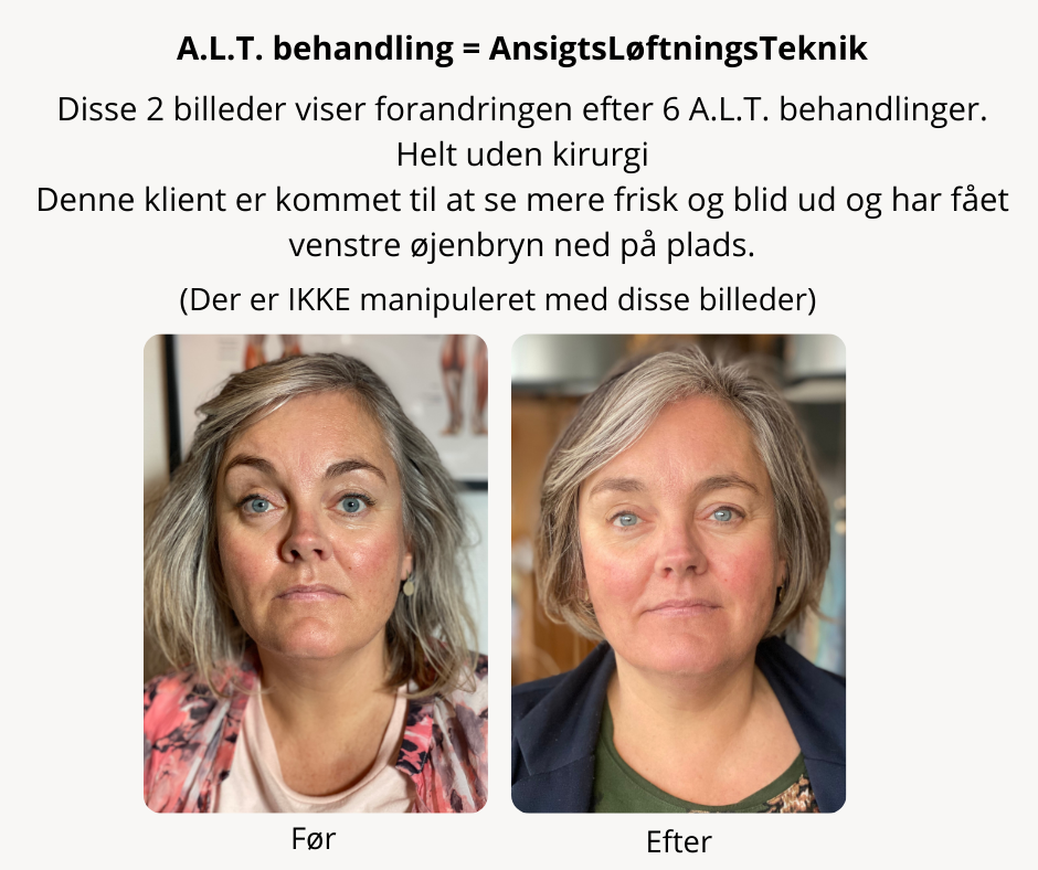 A.L.T. (AnsigtsLøftningsTeknik) Før A.L.T. (AnsigtsLøftningsTeknik) Før