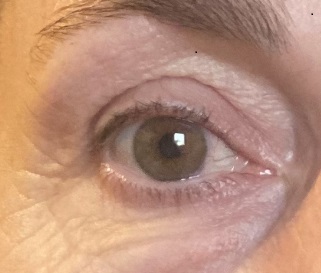 A.L.T. (AnsigtsLøftningsTeknik) efter A.L.T. (AnsigtsLøftningsTeknik) efter